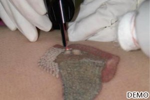 2_Tattoo Removal