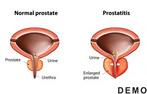 enlarged-prostate