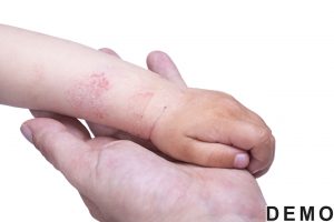 eczema