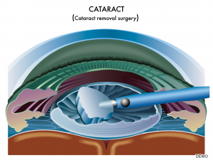 Cataract
