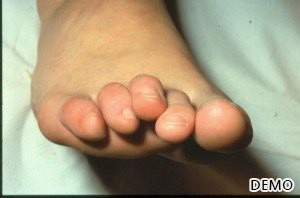 13_Hammertoes Treatment