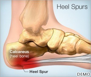 1_Heel Pain Treatment