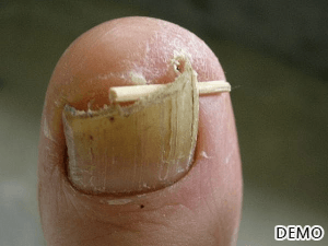 8_Ingrown Toenails Treatment